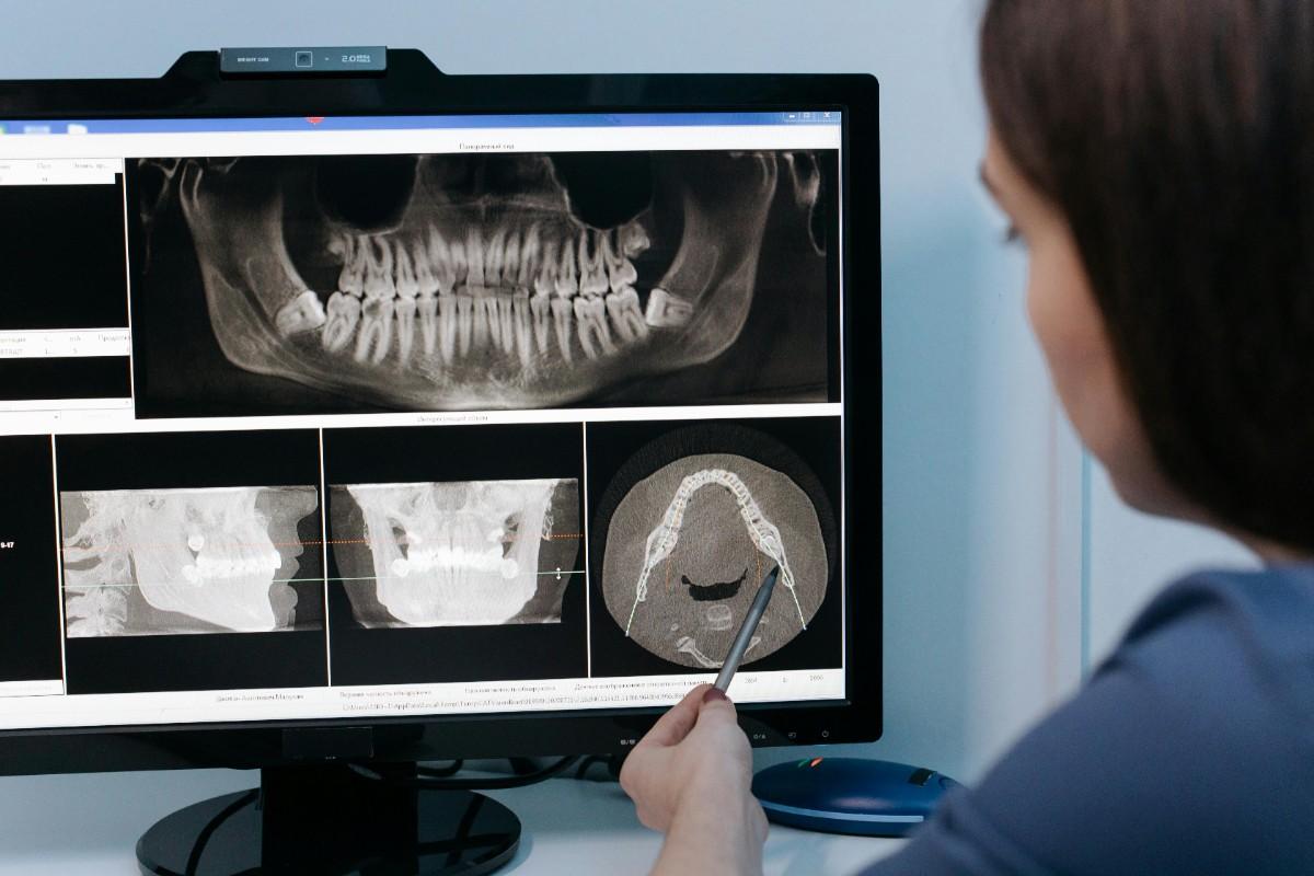 X-ray of front teeth implants