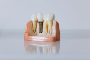 X-ray of front teeth implants