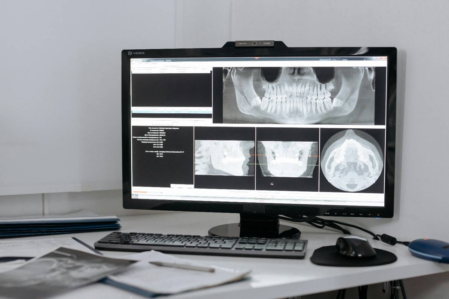 Risks of a femoral cut