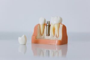 Mini Dental Implants Price